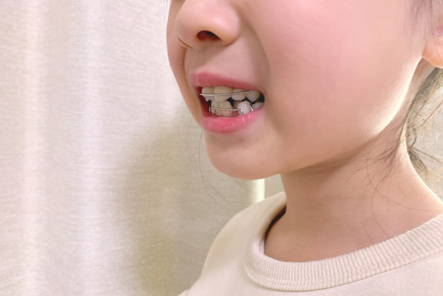 当院で扱う小児矯正治療